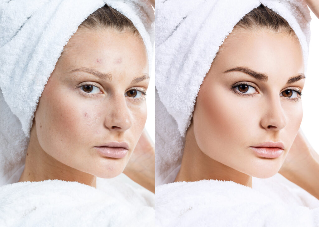Woman face with bath towel on head before and after treatment.