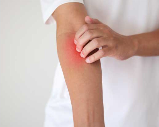 Hautarzt Wien - Dermatologe & Ästhetische Zentrum in Wien - Hautarzt Wien - Dermatologe Ekzeme | Hautarzt Wien - Dermatologe & Ästhetische Zentrum in Wien