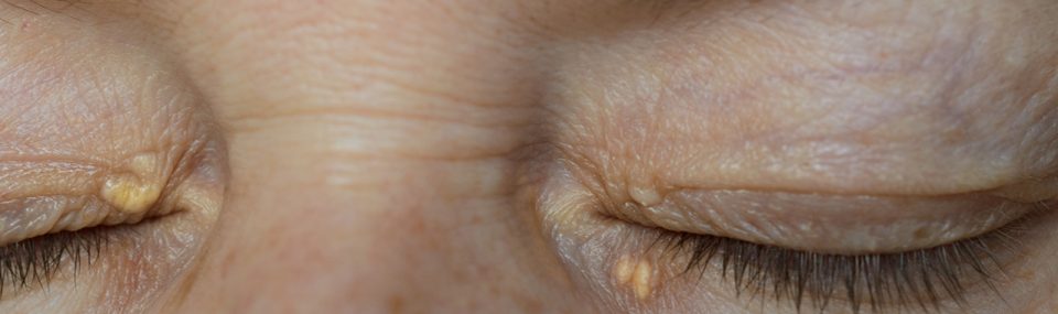 Xanthelasmen | Hautarzt Wien - Dermatologe Zentrum - Hautarzt Wien - Dermatologe eyes with xanthelasma 960x285 1 | Hautarzt Wien - Dermatologe & Ästhetische Zentrum in Wien